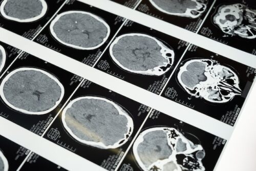 scans of traumatic brain injuries